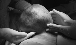 Ngại không đi khám sớm, người bệnh chịu đựng khối u vú nặng gần 4kg