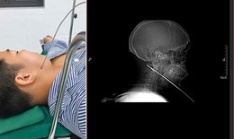 Nam thanh niên đi bắn cá bị mũi tên bật ngược đâm xuyên sâu 15cm vào vùng mặt