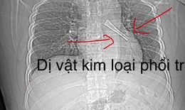 Ho không dứt, bác sĩ phát hiện cán thìa inox mắc trong phế quản bệnh nhân