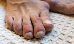Hạt tophi ở người bệnh gout khi nào cần xử trí?