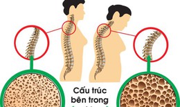 Tuổi nào bắt đầu bị loãng xương và cách phòng bệnh hiệu quả từ sớm