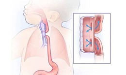Teo thực quản bẩm sinh cần phát hiện sớm