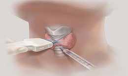 Phát hiện nhân tuyến giáp có nhất thiết phải chọc hút tế bào?