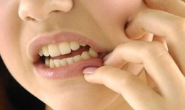 Viêm xương hàm hay bị bỏ qua do triệu chứng dễ nhầm với bệnh răng miệng thông thường