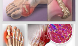 Bị bệnh gout có nên ăn cá?