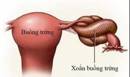Đau bụng dữ dội, buồn nôn phát hiện xoắn u nang buồng trứng