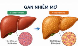 Cách chữa gan nhiễm mỡ độ 1 không dùng thuốc