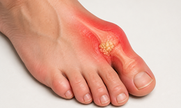 Bệnh gout: 5 bài tập giúp khớp linh hoạt, hỗ trợ kiểm soát acid uric