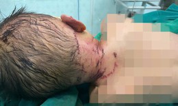 Cảnh báo tình trạng trẻ bị chó cắn ở Thanh Hoá