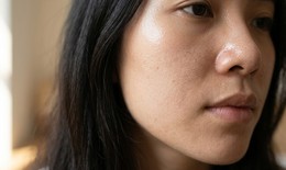 6 sai lầm khi chăm sóc da dầu khiến da càng đổ dầu