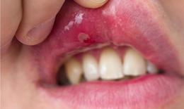 5 lưu ý chăm sóc răng miệng cho người bệnh Lupus ban đỏ