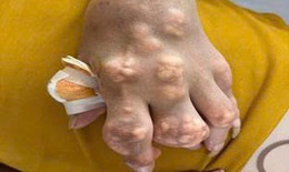 Nhiễm khuẩn huyết do vết loét hạt tophi: Biến chứng chết người từ thói quen của người bệnh gút