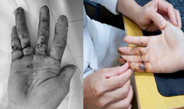 Ngày đầu đi làm, thanh niên 17 tuổi suýt mất 3 ngón tay vì máy cưa