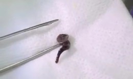 Uống nước ở suối, nam thanh niên bị con đỉa dài 2,5cm chui vào mũi