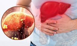 7 dấu hiệu tổn thương gan 