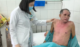 Dị ứng thuốc nhỏ mắt, người đàn ông bị hoại tử thượng bì nhiễm độc nguy kịch