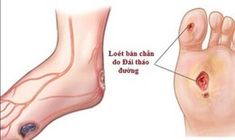 Tê rần bàn chân ở người tiểu đường cần chú ý biến chứng thần kinh