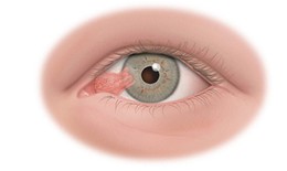 7 dấu hiệu nhận biết xước, rách giác mạc