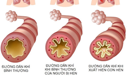 Phòng tránh cơn hen cấp lúc giao mùa