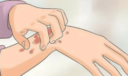 6 cách để giảm khó chịu, hỗ trợ kiểm soát viêm da thần kinh hiệu quả