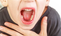 Triệu chứng viêm VA cấp tính và mạn tính ở trẻ em