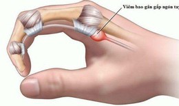 Ngón tay đau hoặc bật lò xo, cảnh giác với viêm gân gấp ngón tay
