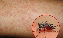 Cô gái tử vong vì sốt xuất huyết, cảnh báo không chủ quan biến chứng bệnh