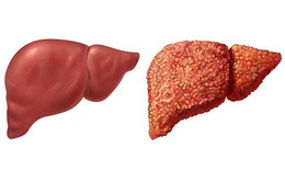 3 biến chứng nguy hiểm của tình trạng tăng men gan