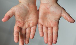 Dung dịch sát khuẩn tay chân miệng cho trẻ loại nào an toàn, giá tốt?