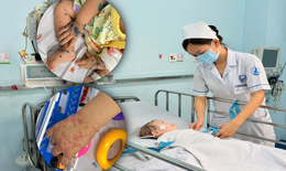 Gần 1/3 ca tay chân miệng nhập viện là ca nặng, bệnh viện dự phòng hơn 100 giường