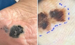 Mảng đen dưới lòng bàn chân: Dấu hiệu ung thư da dễ bị bỏ qua