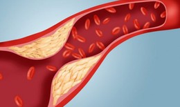 3 hiểu lầm phổ biến về mỡ máu