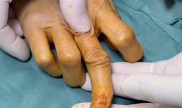 Phẫu thuật chuyển gân thành công cho bệnh nhân bị đứt gân duỗi ngón tay suốt 30 ngày