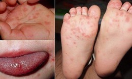 Khánh Hòa đã ghi nhận 3.688 ca tay chân miệng, bác sĩ khuyến cáo điều cần làm