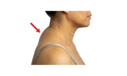 2 bài tập đơn giản tại nhà giúp cải thiện tư thế gù cổ