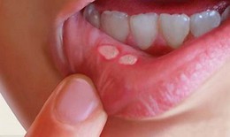 Viêm loét miệng - Bệnh dễ nhầm lẫn