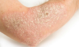 Chia sẻ về căn bệnh “vảy nến” đáng sợ