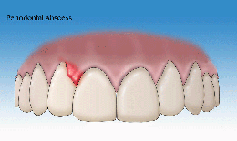 Áp xe nha chu – bệnh lý răng miệng nguy hiểm thường gặp