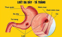 Cách phòng bệnh viêm dạ dày