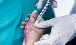 BV Chấn thương chỉnh hình Nghệ An: Điều trị sẹo lồi hiệu quả bằng phương pháp tiêm nội sẹo