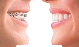 Niềng răng: lợi nhiều hại cũng kh&#244;ng &#237;t