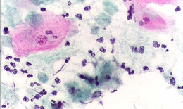 Trị viêm âm đạo do Trichomonas