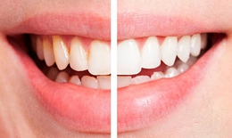 6 mẹo thiên nhiên giúp răng trắng như ngọc