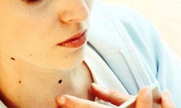 Nốt ruồi mọc lông là đại phú đại quý?