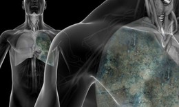 Dấu hiệu nhận biết và cách điều trị bệnh ung thư phổi