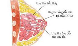 Cảnh báo thuốc trị ung thư docetaxel gây hội chứng ngộ độc rượu