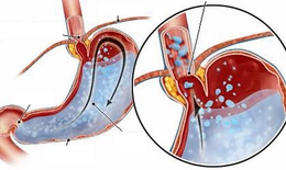 Trị chứng rối loạn tiêu hóa thường gặp ở trẻ
