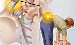 Khắc phục chứng đau thắt lưng
