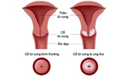 Cách kiểm tra ung thư cổ tử cung
