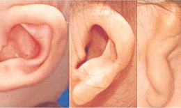 Dị tật tai nhỏ